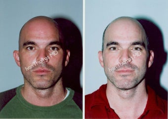 Ear Surgery - Otoplasty before 243394