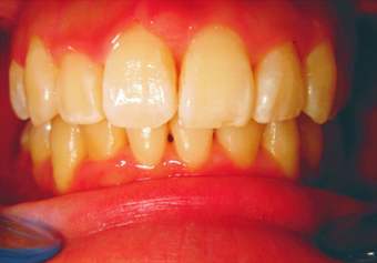 Complex orthodontics with Invisalign after 293389