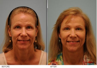 Short Term Botox after 345398