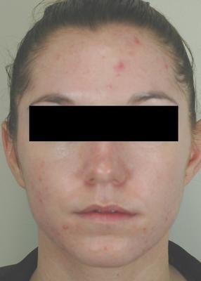 Laser Acne Treatment before 82976