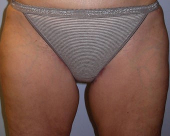 Thigh Lift after 375711