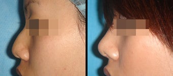 Rhinoplasty before 650742