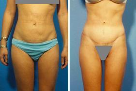 Abdominoplasty before 356409