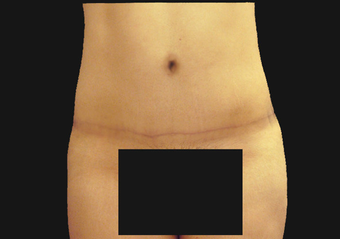 Andominoplasty 458930