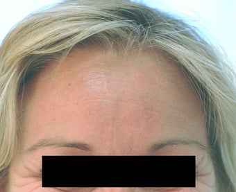Dysport Injections Orange County Before and After before 349211