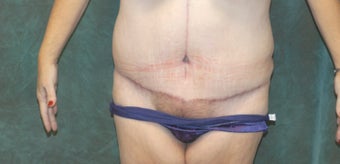 Women's Tummy Tuck Revision after 558747