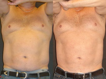 SmartLipo before 96259