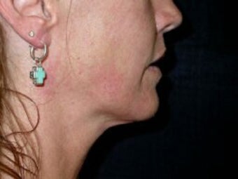 Thermage Treatment before 124645