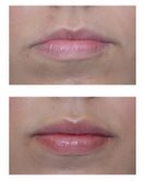 Restylane Injections for Lip Augmentation before 53752