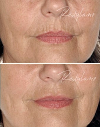 Before and after Restylane on fine lines before 6273