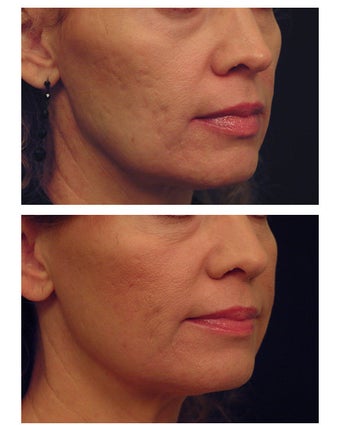 YAG Laser Skin Tightening after 490522