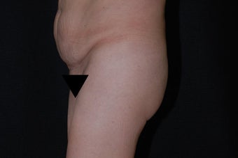 Buttock Augmentation through Fat Transfer 423709