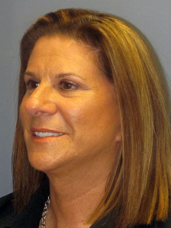 Neck Lift, Platysmalasty 634751