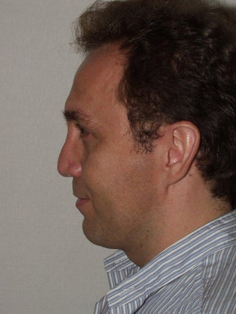 Revision Rhinoplasty before 299764