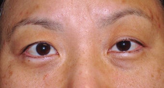 Upper Blepharoplasty before 365448
