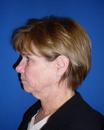 Laser Mini Facelift before 179309