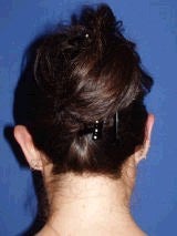 Ear Surgery (Otoplasty) 357657