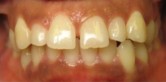 Invisalign 436971