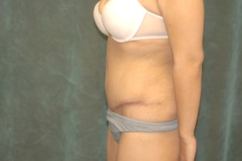 Women's Tummy Tuck Revision 558745