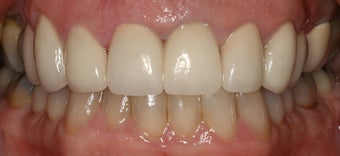 porcelain crowns and porcelain veneers after 312959
