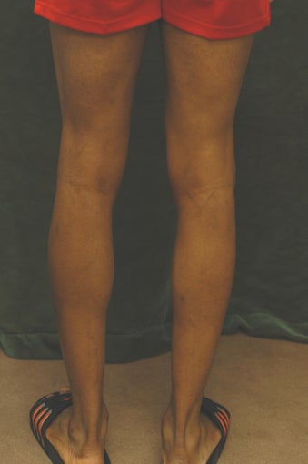 Men's Calf Augmentation before 519061