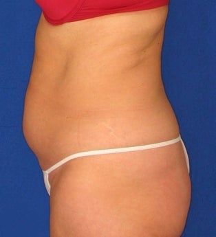 Liposuction, SmartLipo™ before 312311