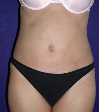 Tummy Tuck (abdominoplasty) after 208478