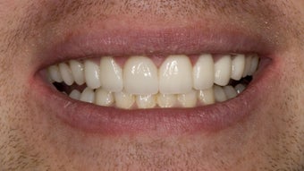Porcelain Bridge and Veneer after 374681