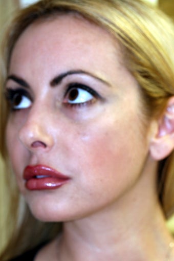 Rhinoplasty and Septoplasty after 572375