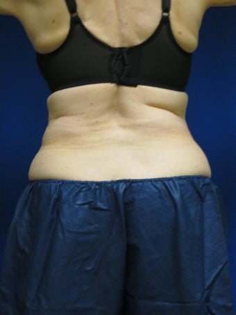 Coosculpting after 584384