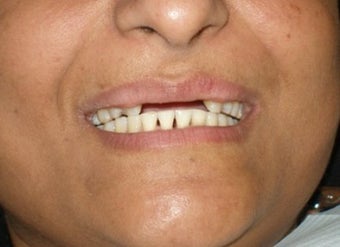 Cosmetic Dentistry Fixed Prosthesis before 254543