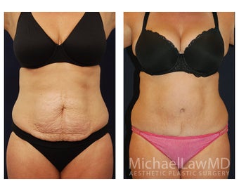 Abdominoplasty - Tummy Tuck before 396176