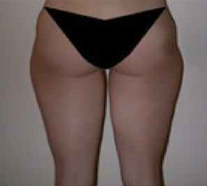 Liposuction before 91871