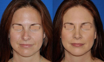 Revision Rhinoplasty before 293542