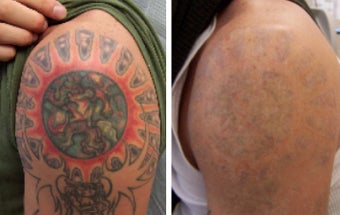 Laser tattoo removal before 369209