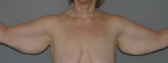 Arm-lift, Brachioplasty before 564065