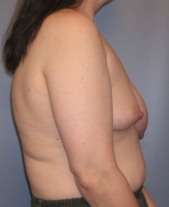 Reconstruction for Problem Breasts before 130678