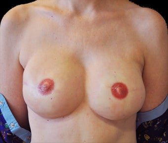 Breast reconstruction with silicone implants after 476705