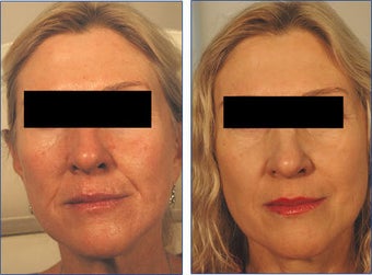 Restylane for Laugh Lines Before and After Photo before 396171
