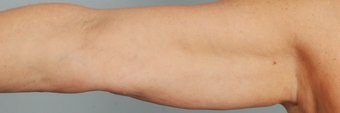 Smart Lipo before 143175