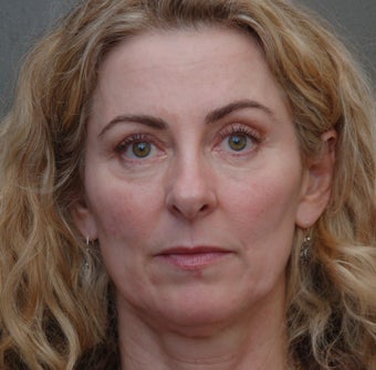 Under Eye Dermafiller, Cheek Dermafiller, Restylane before 208582