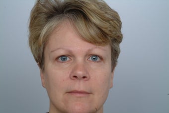 Endoscopic Brow Lift before 250438