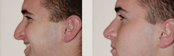 Primary Rhinoplasty before 271735