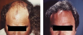 hair transplant before 369170