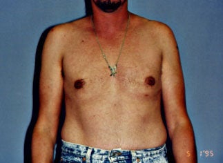 Male Breast Reduction after 264606