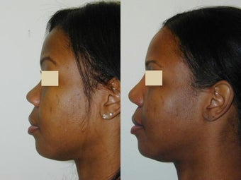 African American Rhinoplasty before 137714