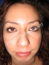 Chin Implants, Nose Surgery (Rhinoplasty) 622588