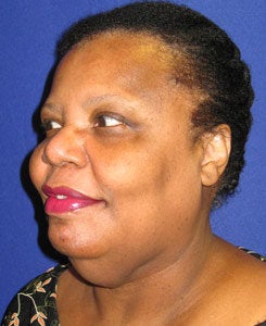 Face Lift, Neck Lift, Neck Liposuction before 338010