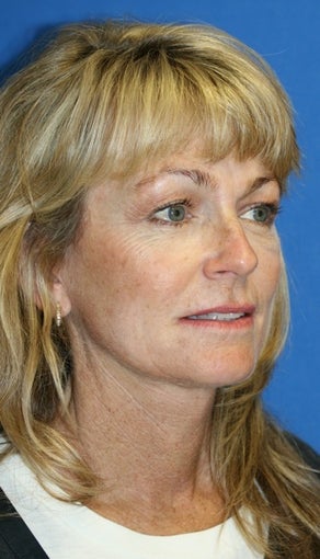 Short Incision face lift and neck lift after 223347