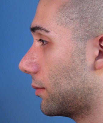 Revision Rhinoplasty 410801